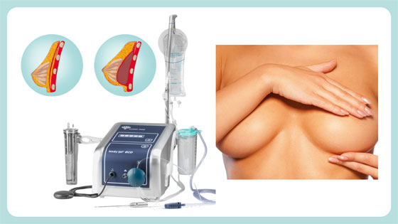 Cirugía Plástica · Cirugía de Mama · Tecnología WAL | UpViser Spain