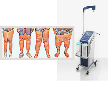 Surgical Treatment of Lipedema | Blog UpViser Spain